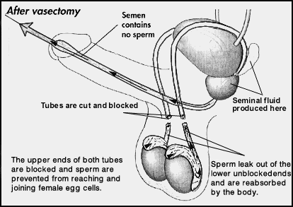 Laser vasectomy Ontario